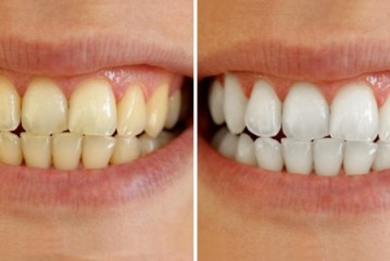 תראו איך מלבינים את השיניים ב-3 דקות